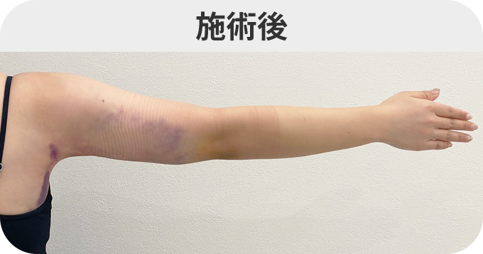二の腕スリム脂肪吸引ダウンタイムの症例写真
