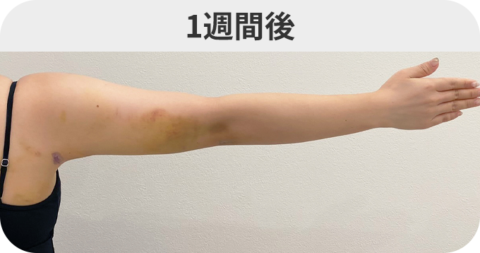 二の腕スリム脂肪吸引ダウンタイムの症例写真