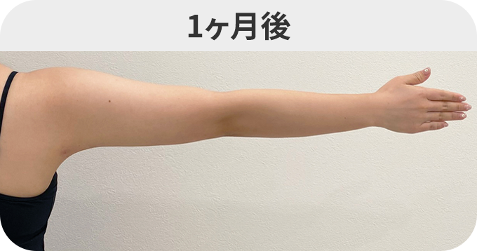 二の腕スリム脂肪吸引ダウンタイムの症例写真