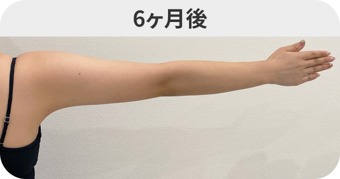 二の腕スリム脂肪吸引ダウンタイムの症例写真