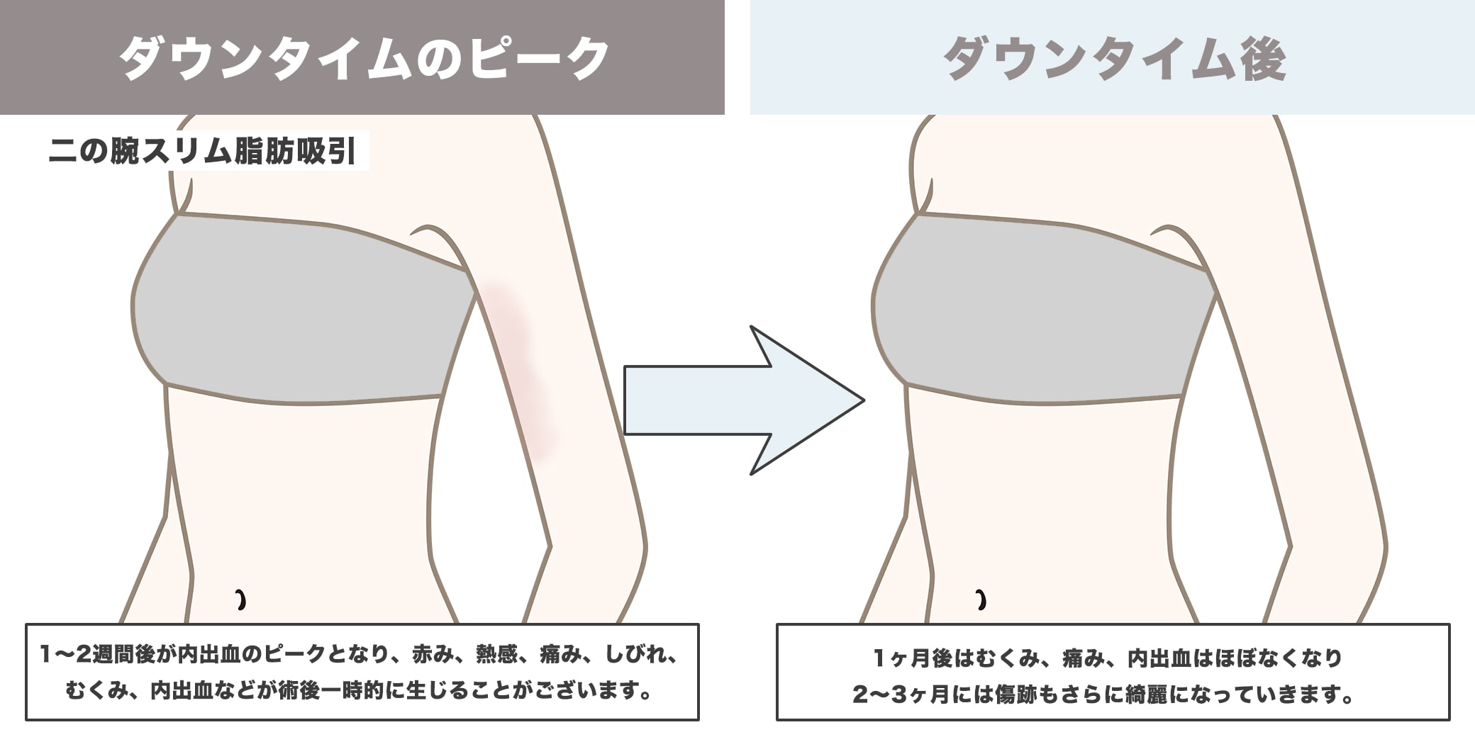 二の腕スリム脂肪吸引のダウンタイムイラスト