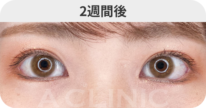パーフェクトアイズ®ダウンタイムの症例写真