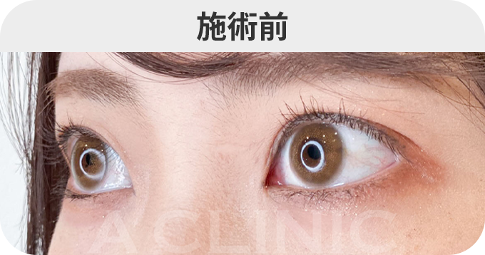 パーフェクトアイズ®ダウンタイムの症例写真
