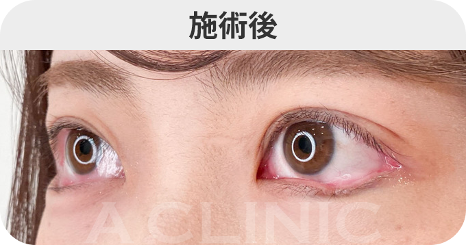 パーフェクトアイズ®ダウンタイムの症例写真