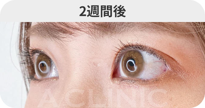 パーフェクトアイズ®ダウンタイムの症例写真