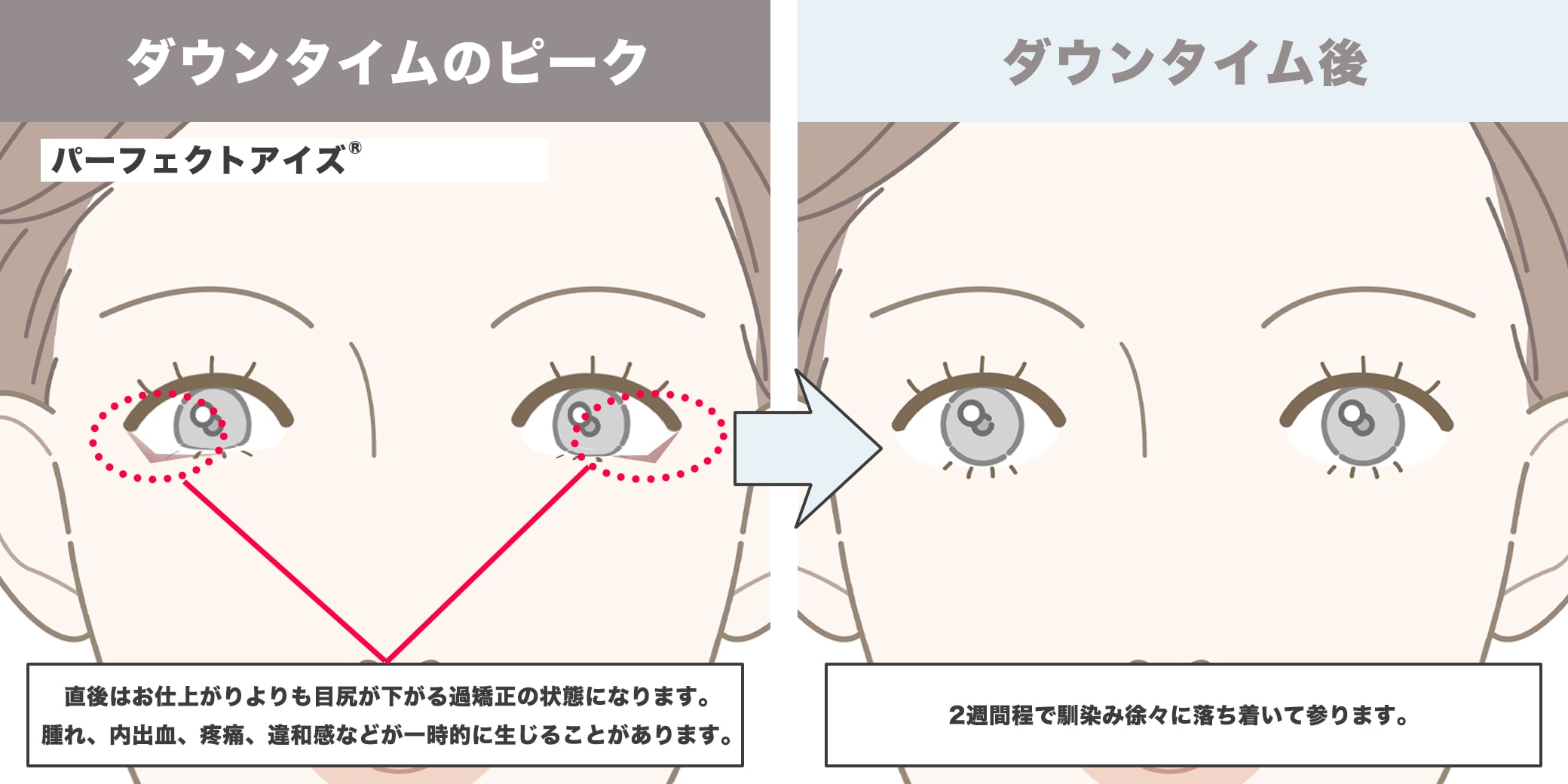 パーフェクトアイズ®のダウンタイムイラスト