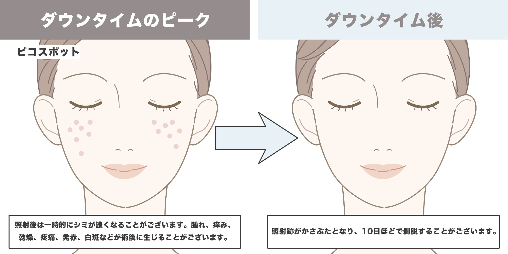 ピコスポットのダウンタイムイラスト