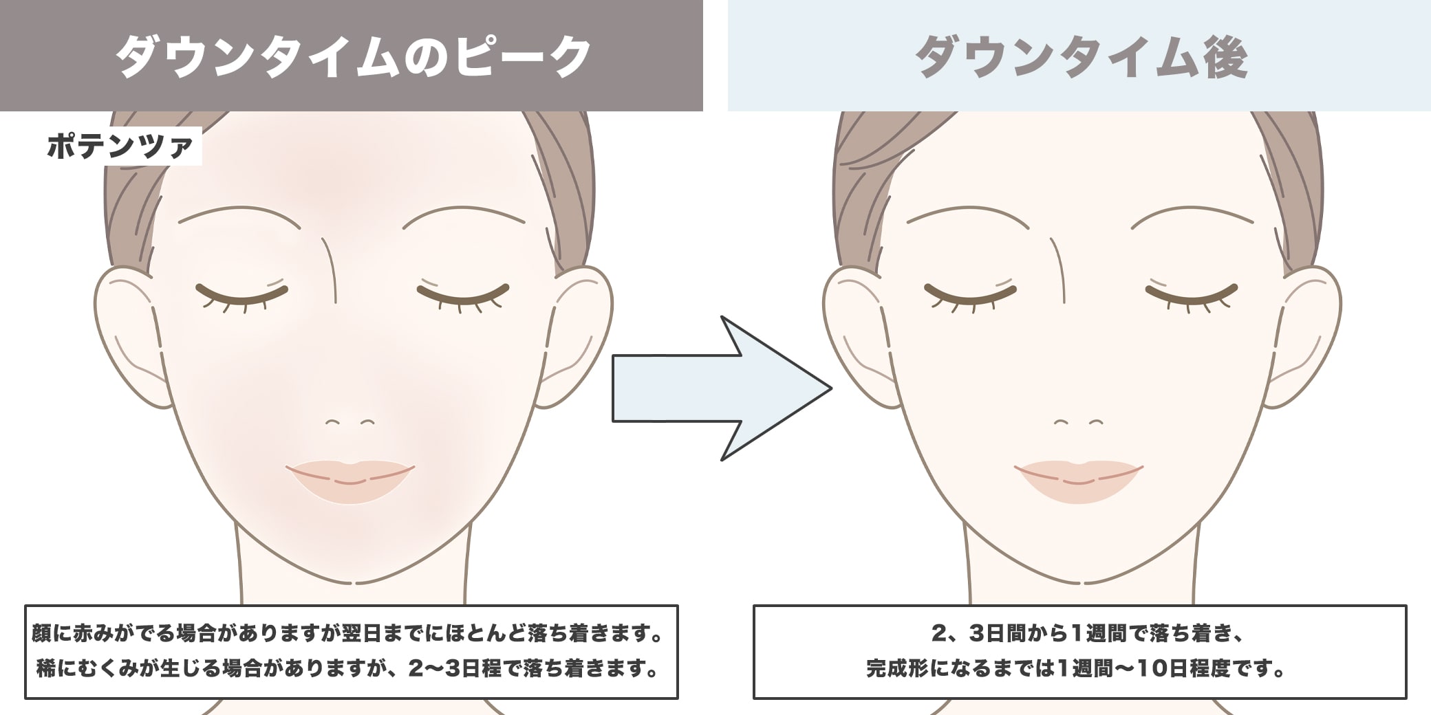 ポテンツァのダウンタイムイラスト