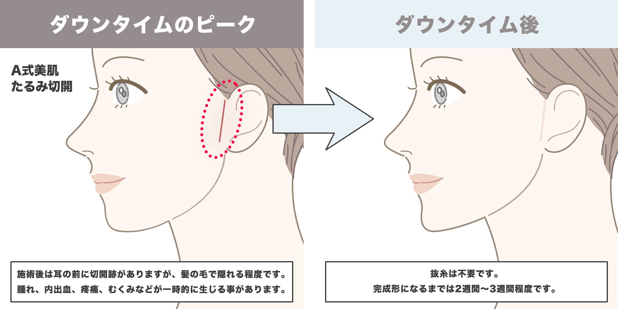 A式美肌たるみ切開のダウンタイムイラスト