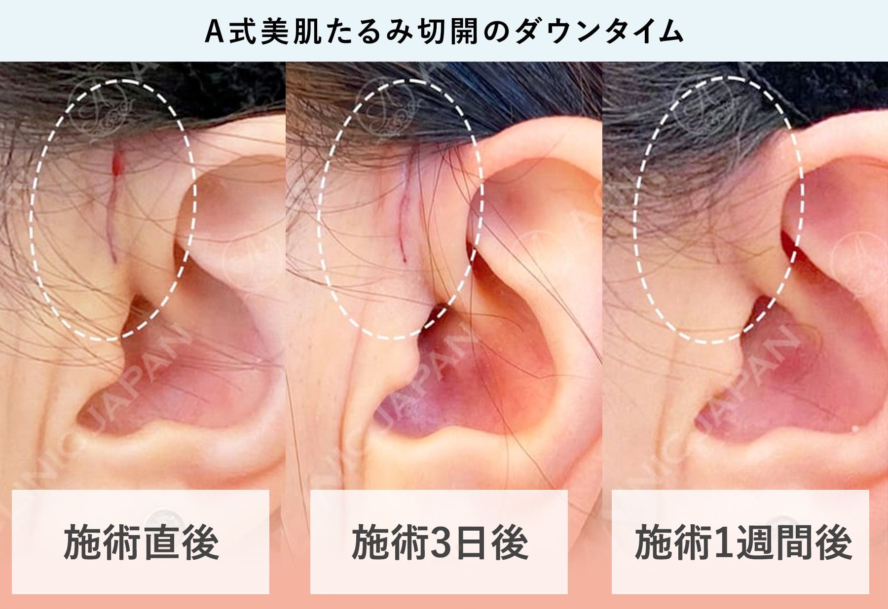 ダウンタイムのの症例写真