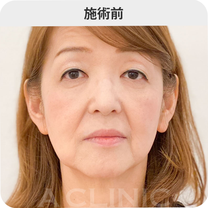 A式美肌たるみ切開ダウンタイムの症例写真