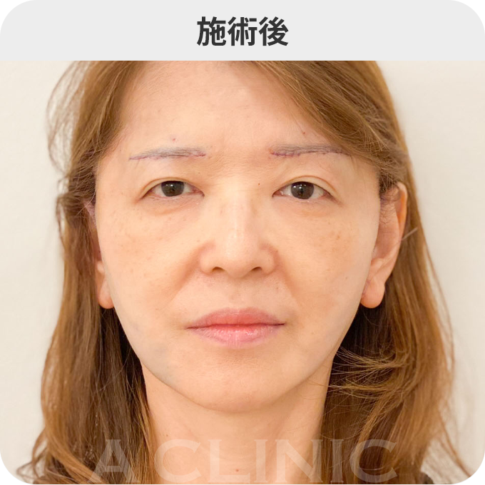 A式美肌たるみ切開ダウンタイムの症例写真