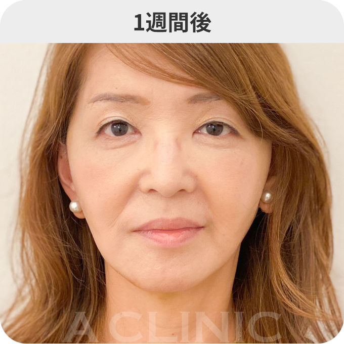 A式美肌たるみ切開ダウンタイムの症例写真