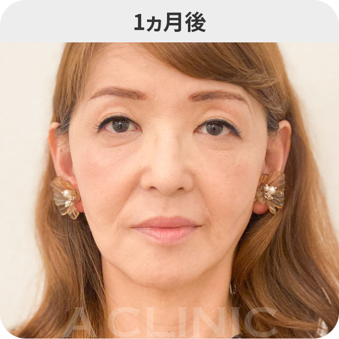 A式美肌たるみ切開ダウンタイムの症例写真