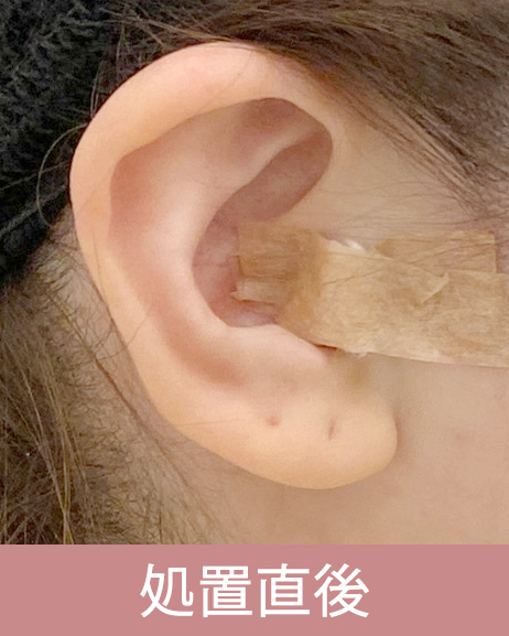 耳珠軟骨移植の経過