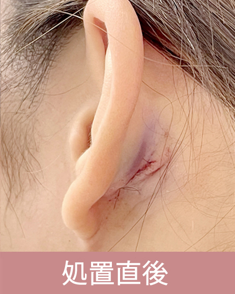 耳介軟骨移植の経過