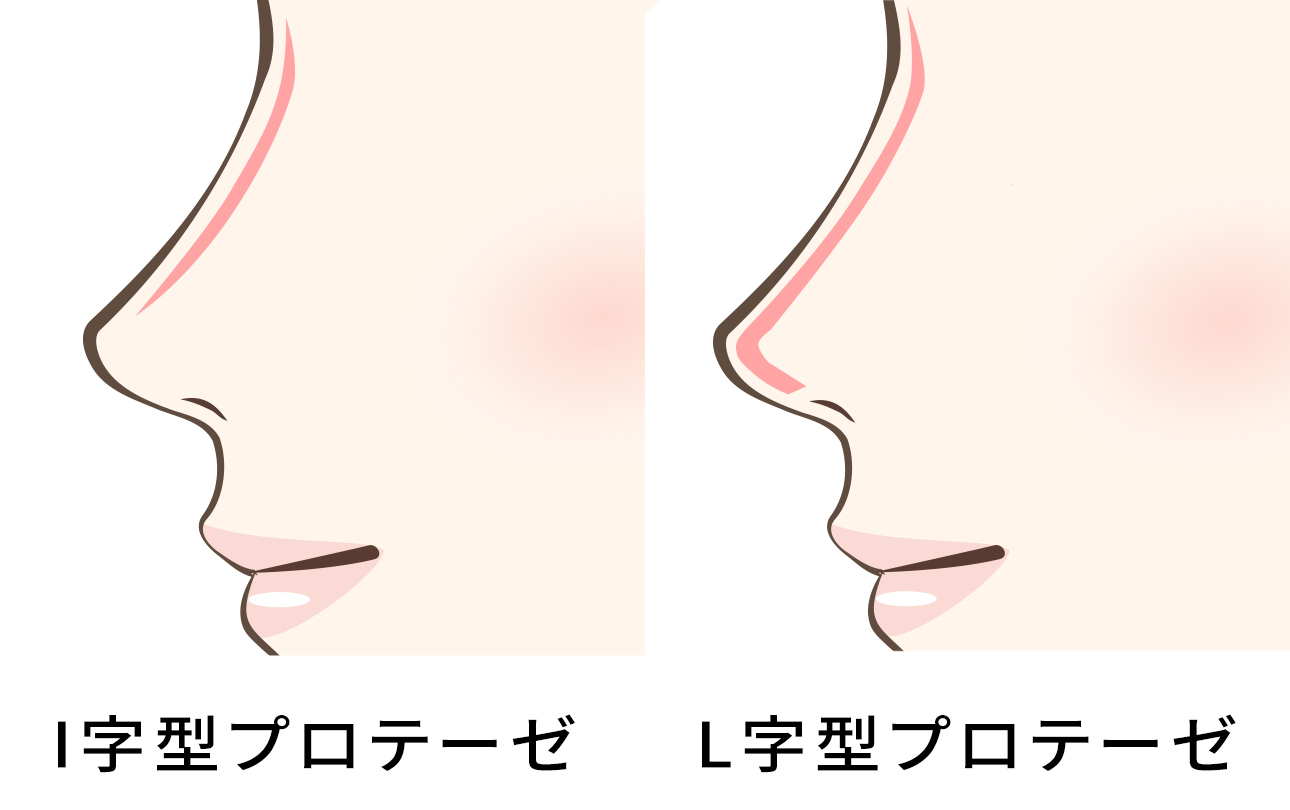 鼻プロテーゼ(隆鼻術)