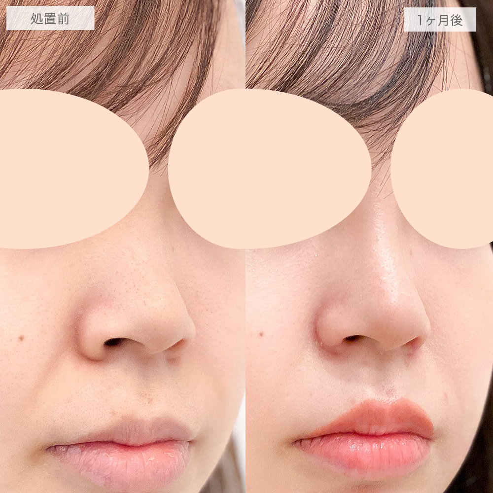 鼻プロテーゼ(隆鼻術)の症例写真