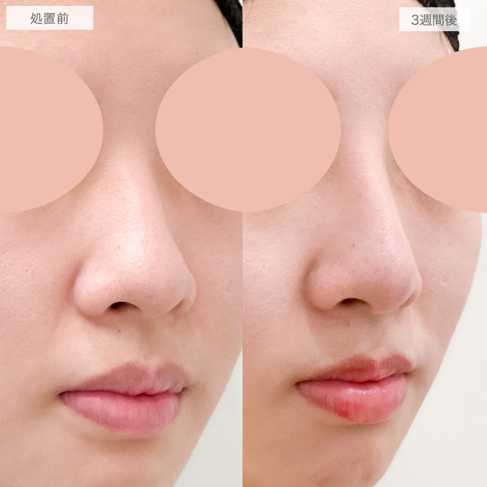 鼻プロテーゼ(隆鼻術)の症例写真