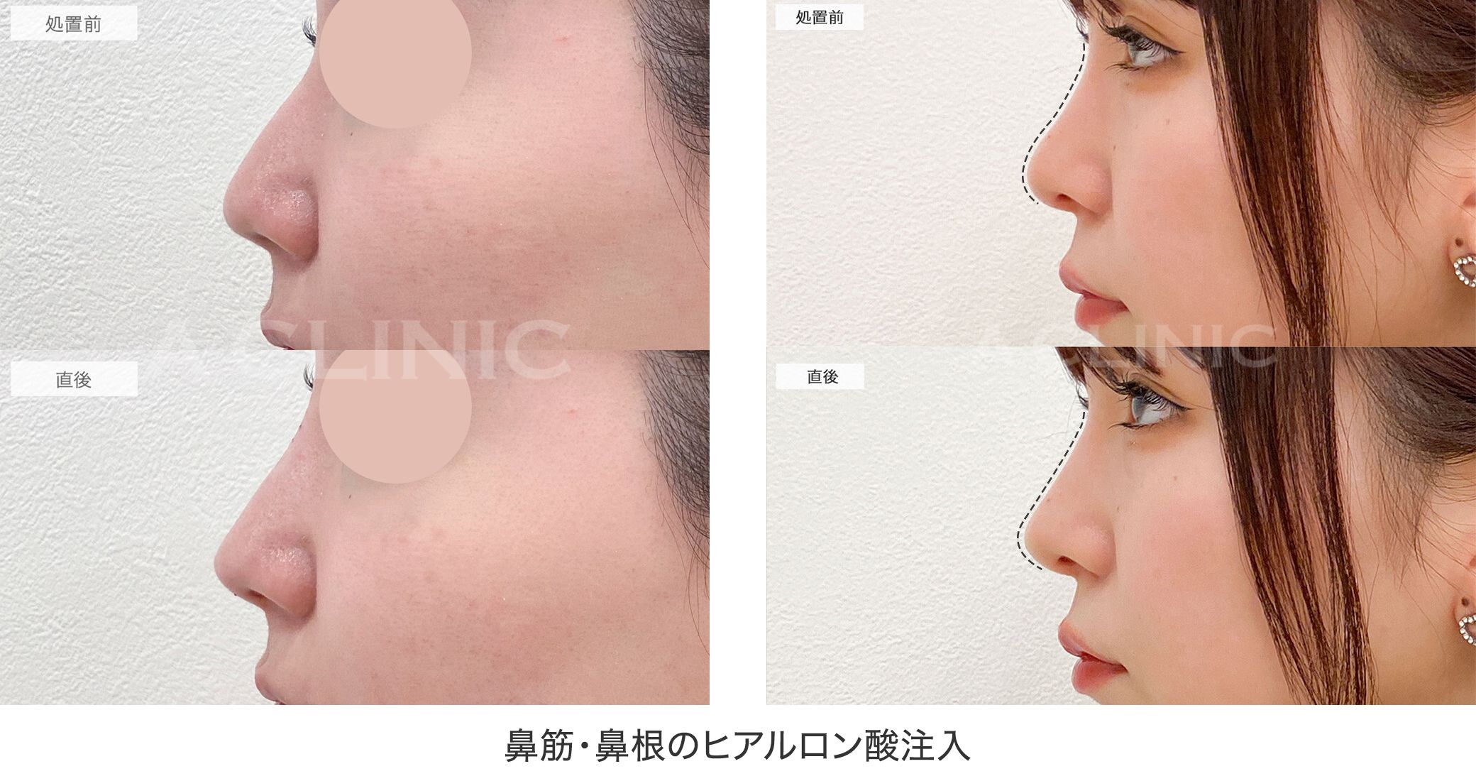 ヒアルロン酸鼻筋・鼻根の症例
