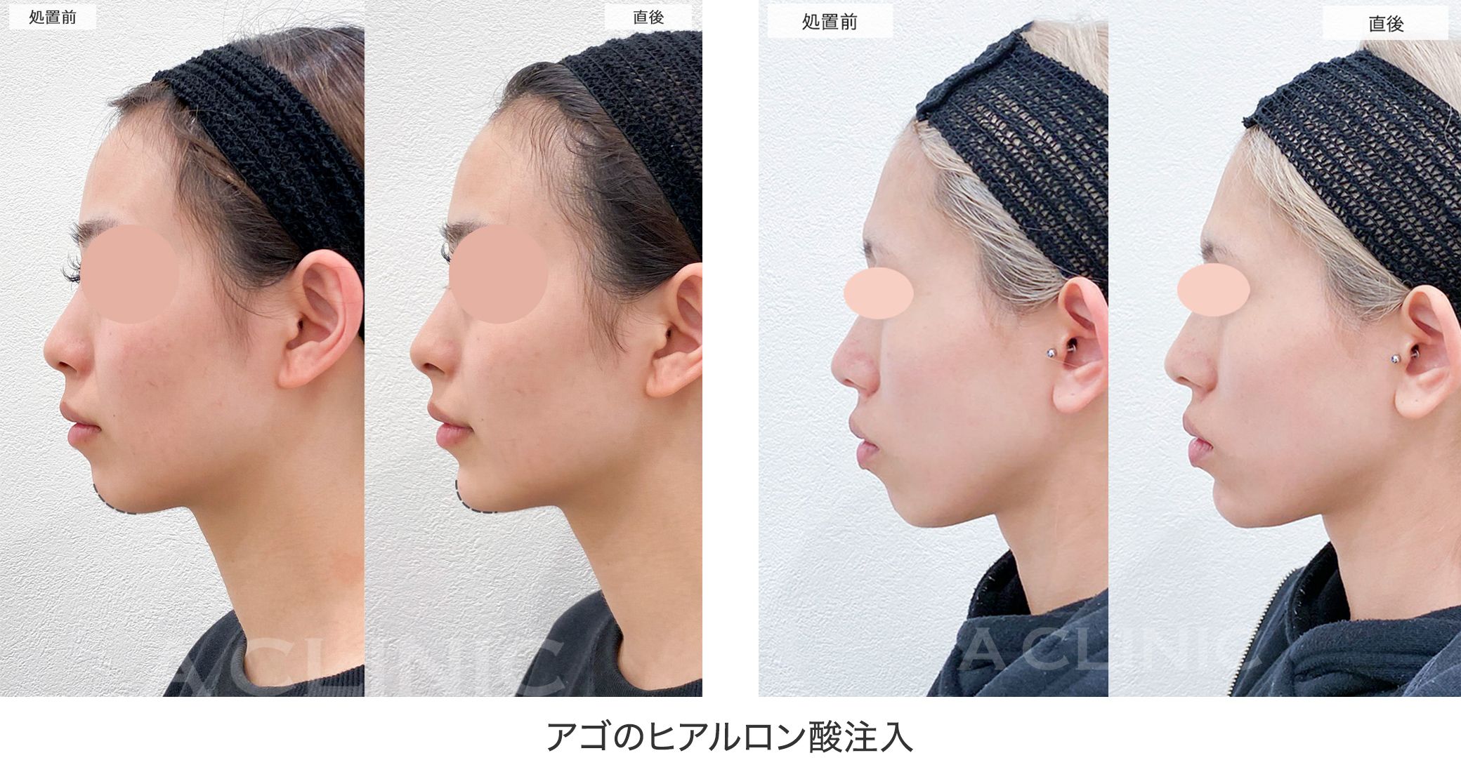 ヒアルロン酸顎（アゴ）の症例