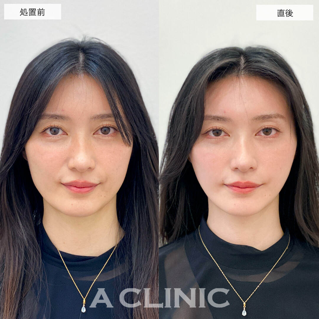 Aスレッド®︎脂肪吸引