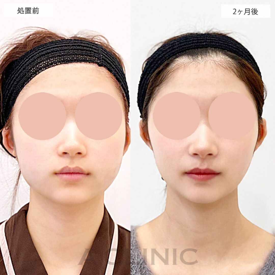 1day小顔脂肪吸引モニター