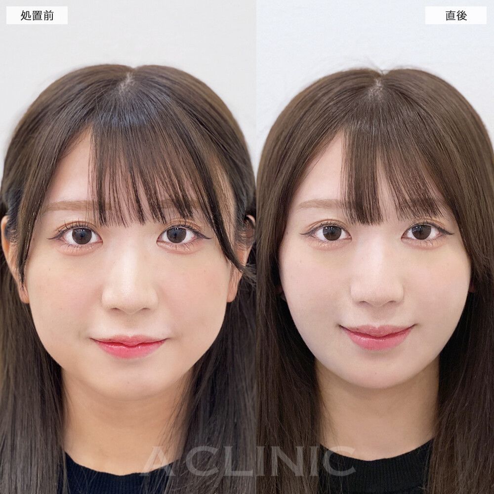 1day小顔脂肪吸引モニター