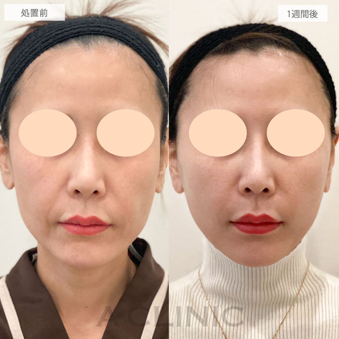 A式美肌たるみ切開