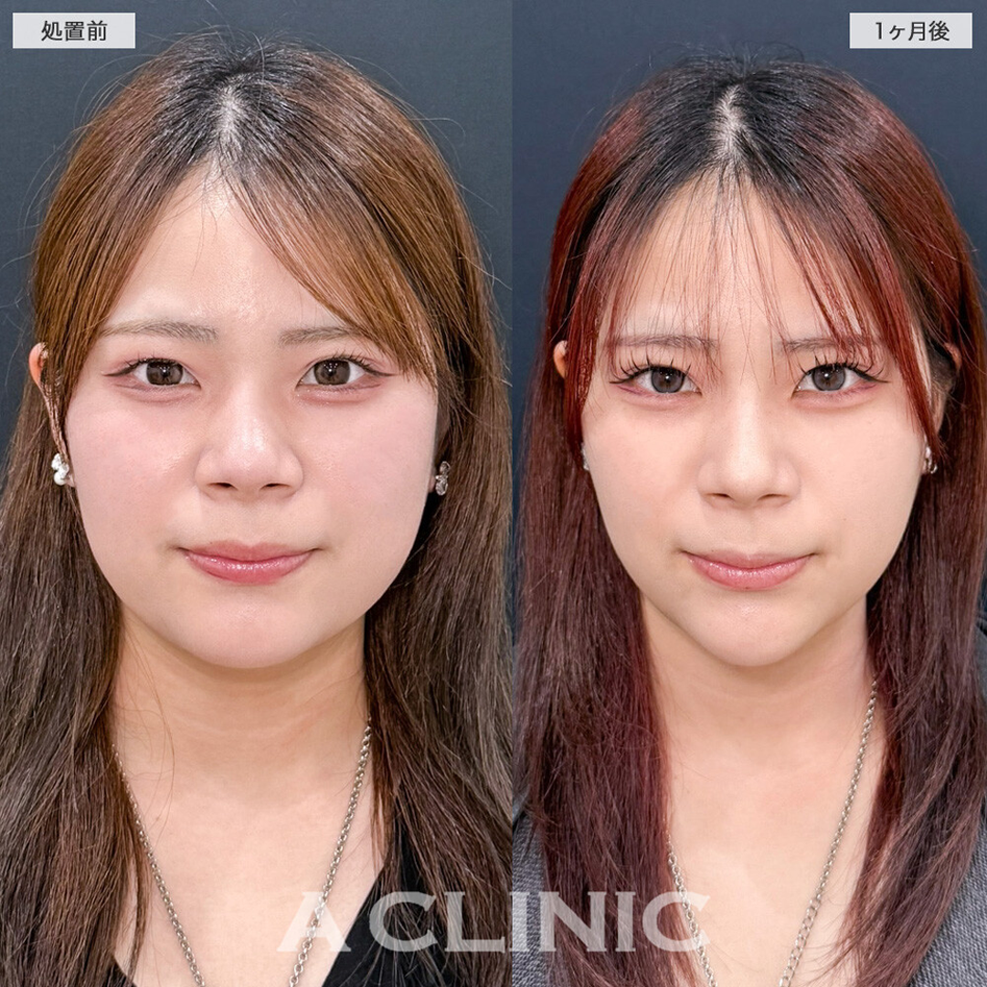 1day小顔®︎脂肪吸引