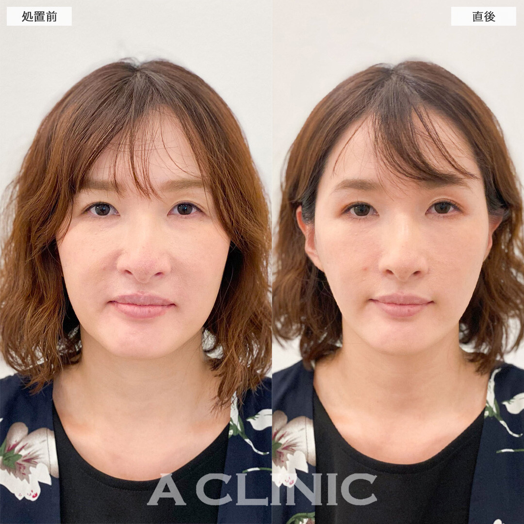 Aスレッド®︎