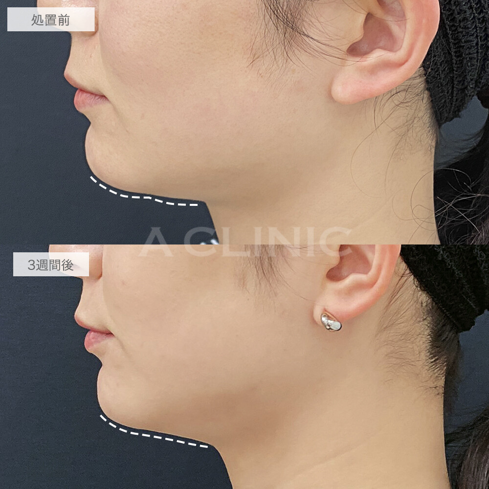 耳下腺、顎下腺(唾液線ボトックス)の症例写真
