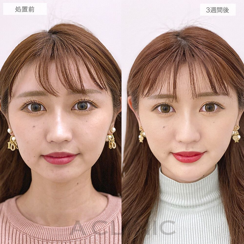 顔の脂肪吸引の症例写真