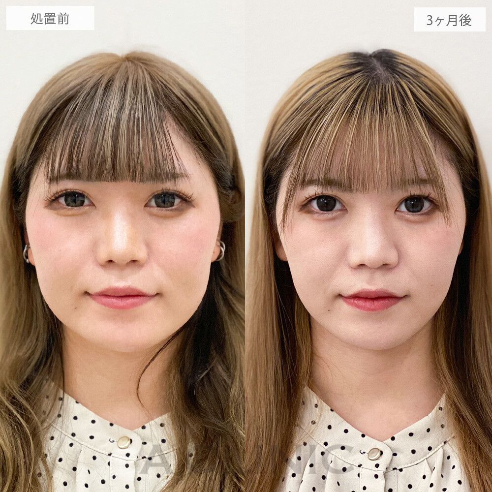 顔の脂肪吸引の症例写真
