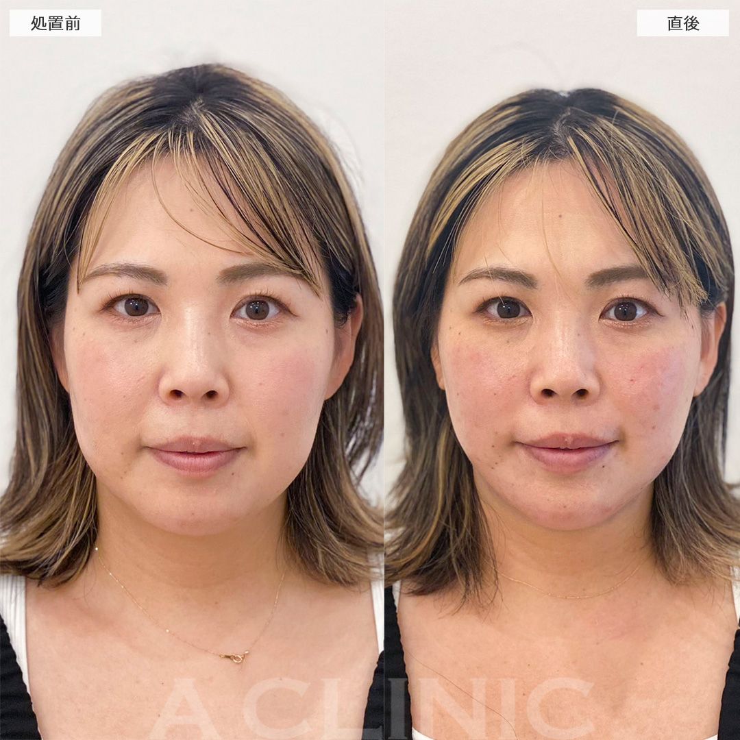 顔の脂肪吸引の症例写真