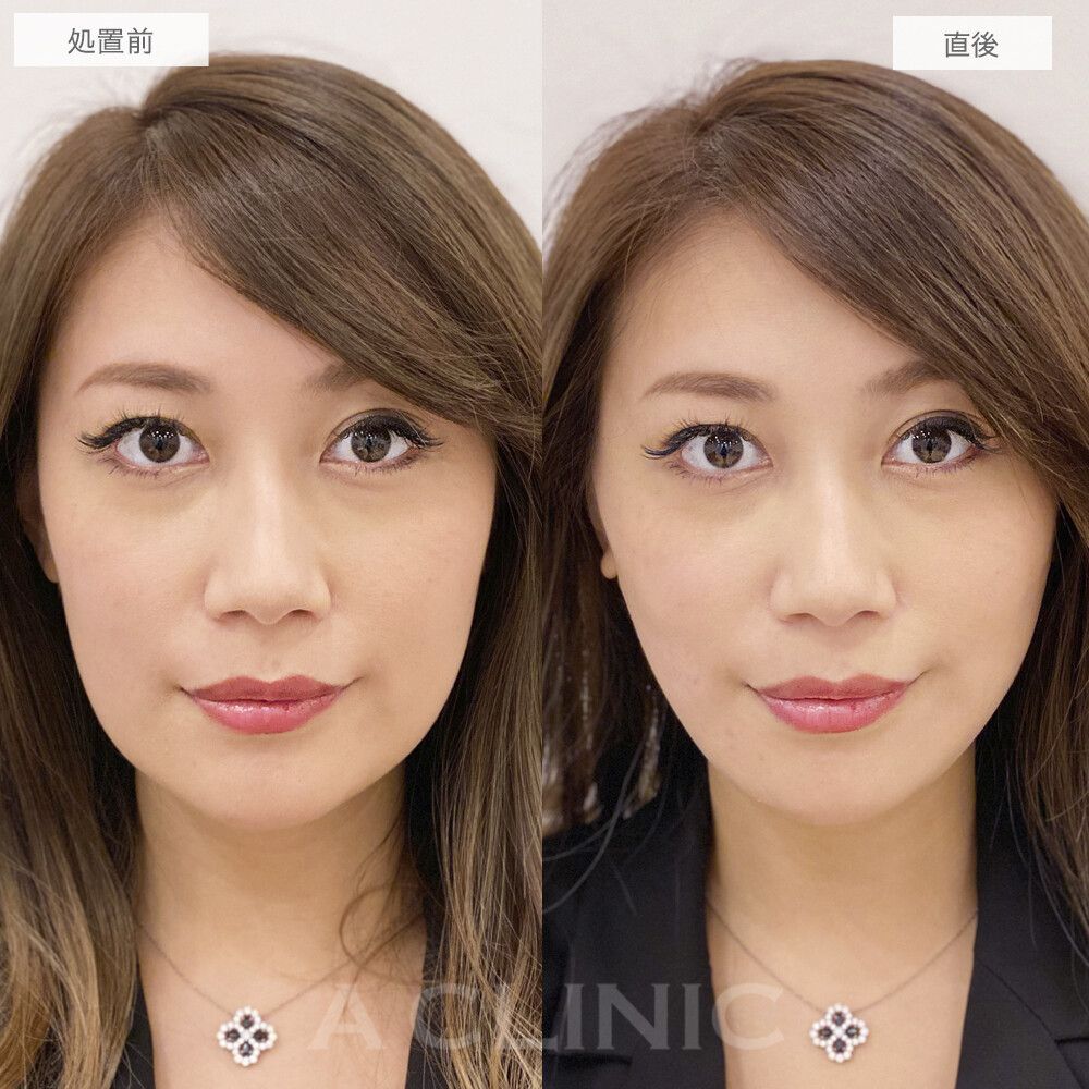 顔の脂肪吸引の症例写真