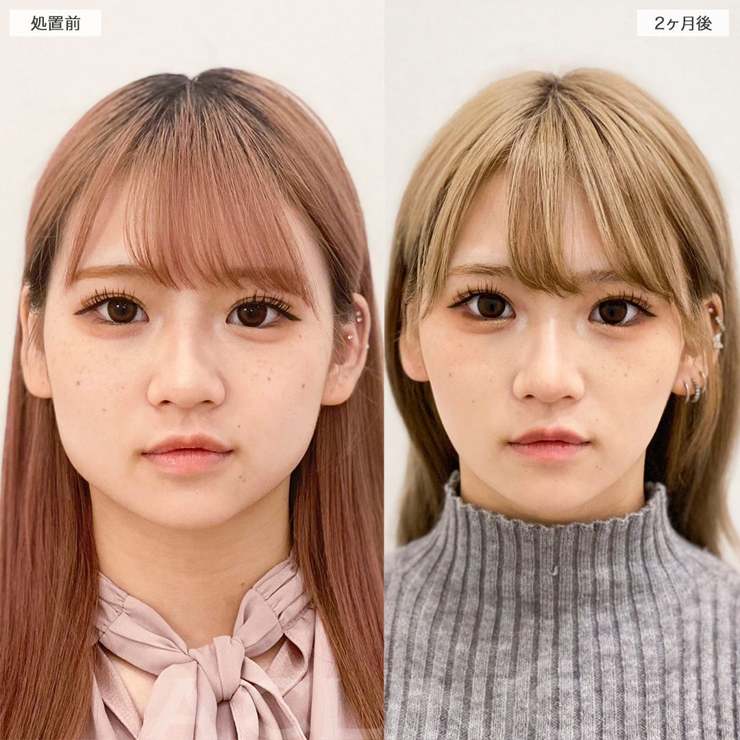 顔の脂肪吸引の症例写真