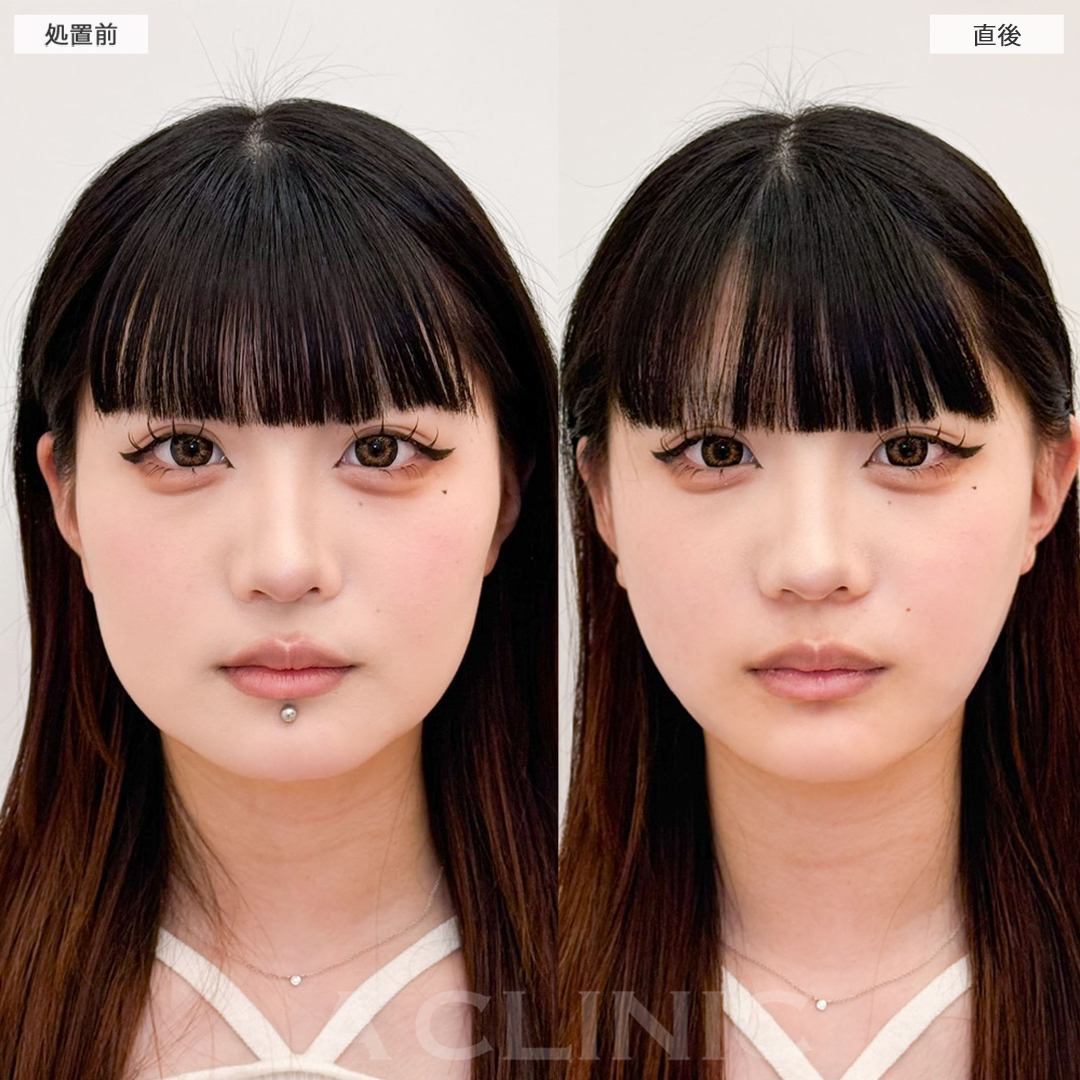 顔の脂肪吸引の症例写真