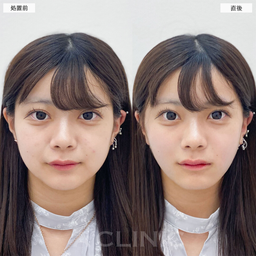顔の脂肪吸引の症例写真