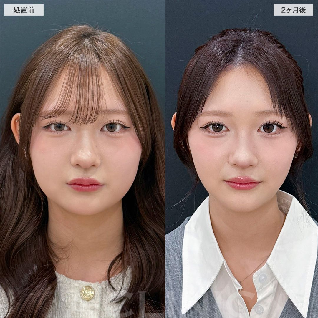 顔の脂肪吸引の症例写真