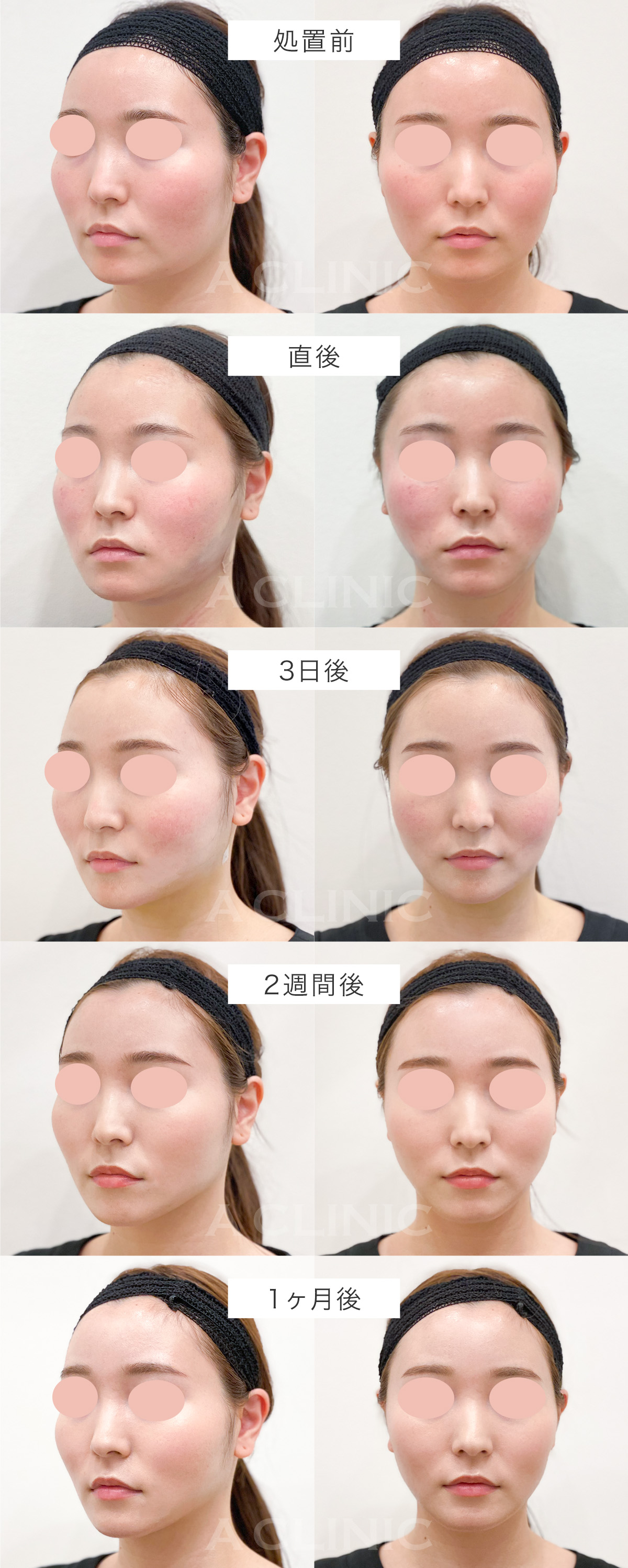 顔の脂肪吸引