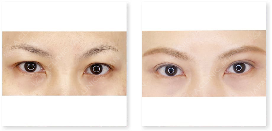 目と眉短縮術症例写真