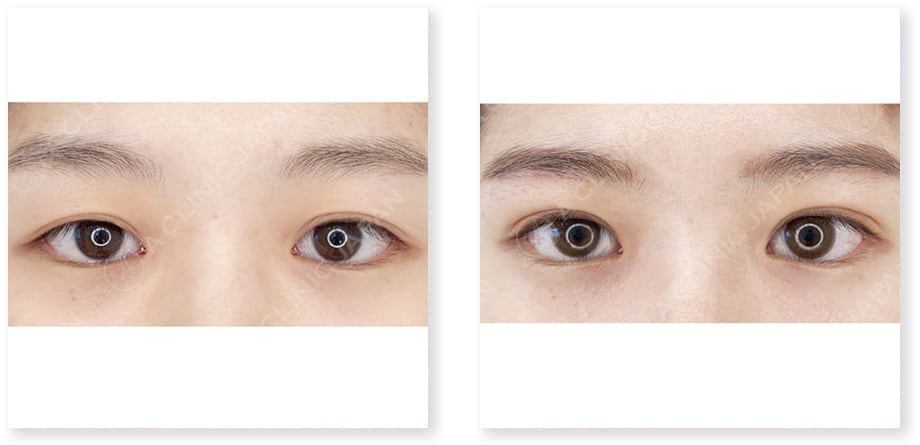 目と眉短縮術症例写真