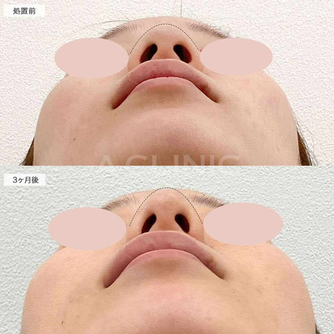 鼻プロテーゼ＋小鼻縮小術切開法の症例写真