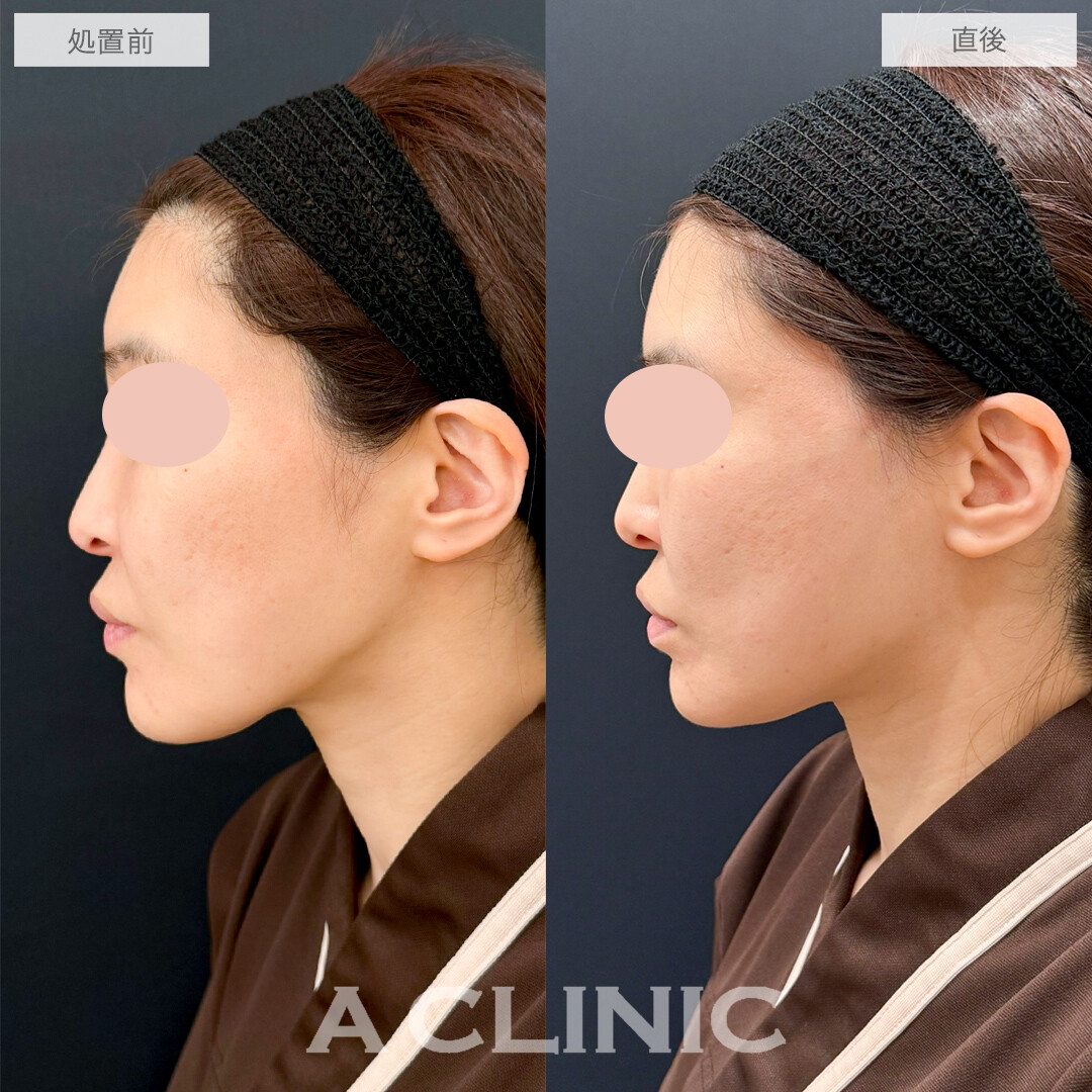 オートクチュールリフト症例写真