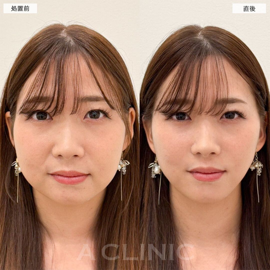 Aスレッド症例写真