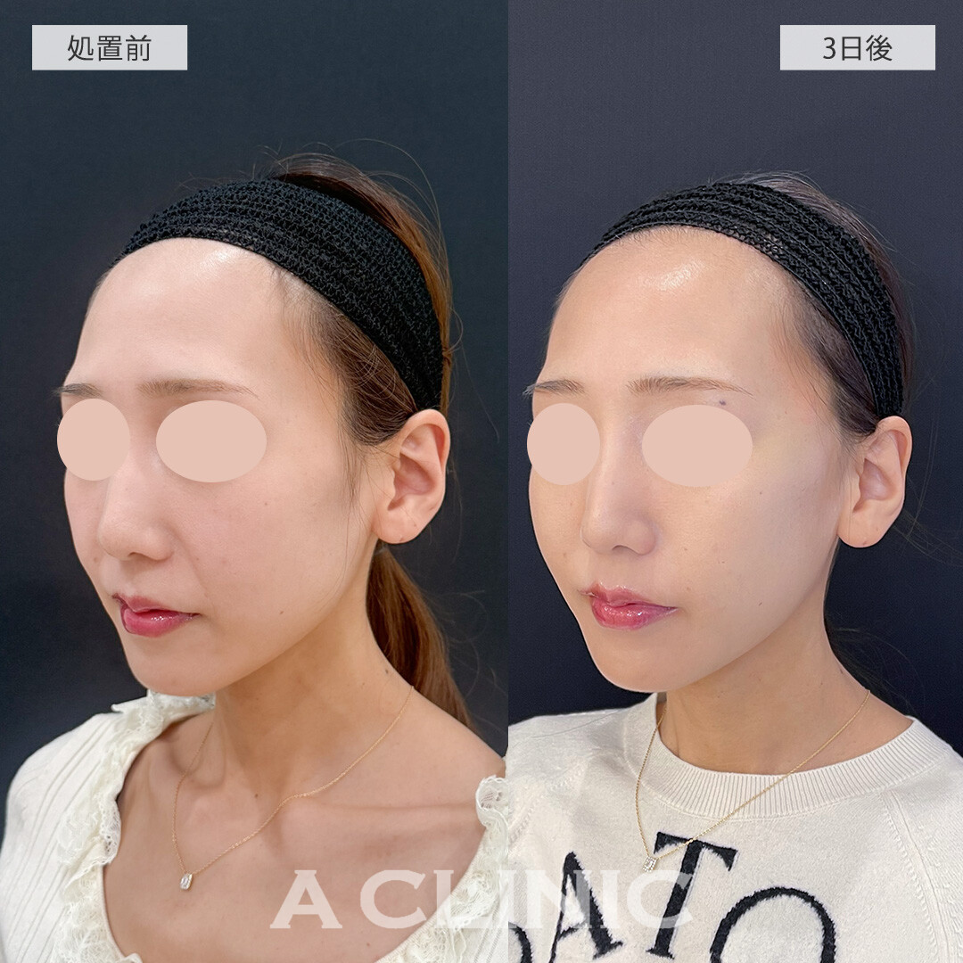 バーティカルリフトの症例写真