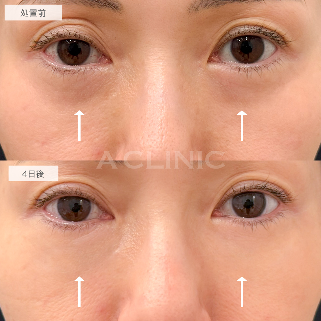 A式コンシーラー注射の症例写真