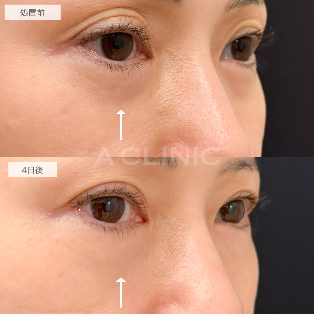 A式コンシーラー注射の症例写真