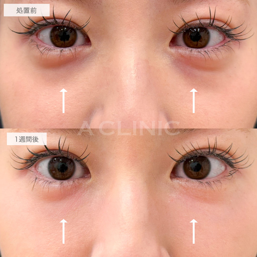 A式コンシーラー注射の症例写真